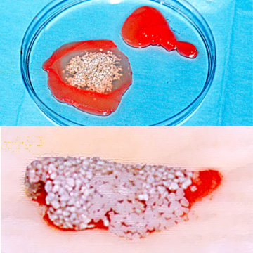 associazione-gel-piastrinico-con-biomateriale