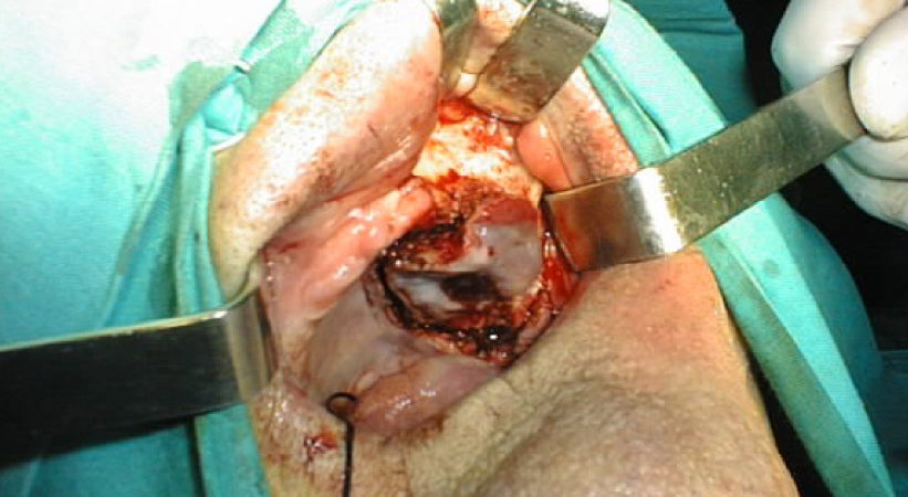 1-carcinoma-squamoso-infiltrante-dellemipalato-duro-di-sinistra 1-carcinoma-squamoso-infiltrante-dellemipalato-duro-di-sinistra