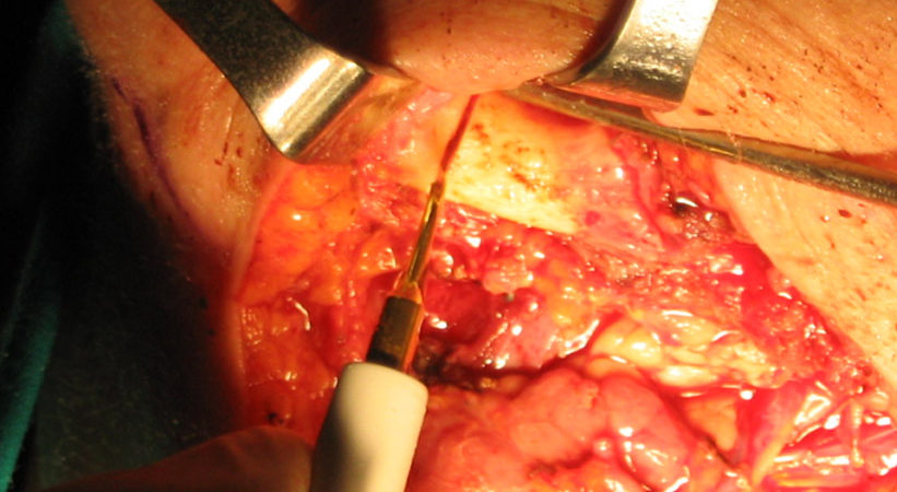1-osteotomia-piezoelettrica-condotta-a-livello-parasinfisario 1-osteotomia-piezoelettrica-condotta-a-livello-parasinfisario
