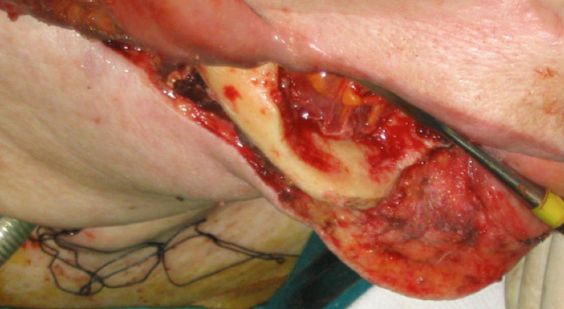 2-osteotomia-piezoelettrica-condotta-a-livello-della-sinfisi-mentoniera 2-osteotomia-piezoelettrica-condotta-a-livello-della-sinfisi-mentoniera