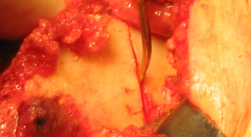 2-osteotomia-piezoelettrica-condotta-allangolo-mandibolare 2-osteotomia-piezoelettrica-condotta-allangolo-mandibolare