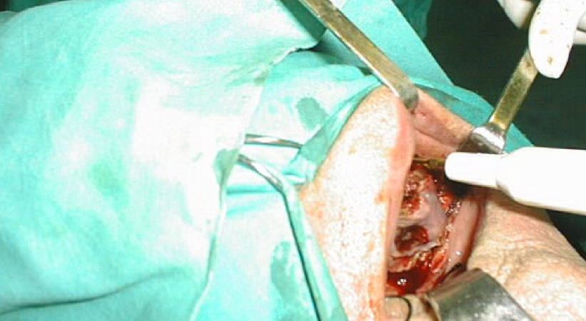 2-una-fase-dellosteotomia-piezoelettrica 2-una-fase-dellosteotomia-piezoelettrica