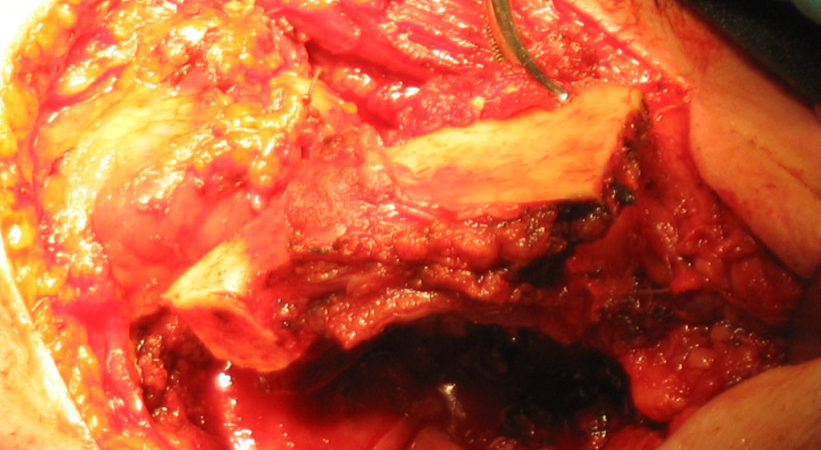 3-il-tumore-viene-rimosso-in-monoblocco-con-losso-mandibolare 3-il-tumore-viene-rimosso-in-monoblocco-con-losso-mandibolare