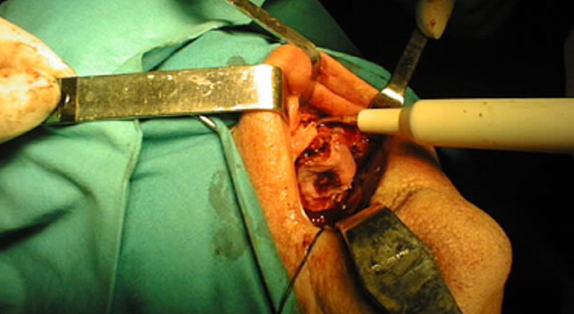 3-linserto-piezoelettrico-delimita-i-margini-della-maxillectomia-parziale 3-linserto-piezoelettrico-delimita-i-margini-della-maxillectomia-parziale