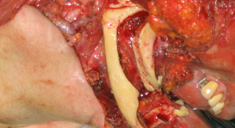 3-osteotomia-piezoelettrica-del-corpo-e-del-ramo-mandibolare 3-osteotomia-piezoelettrica-del-corpo-e-del-ramo-mandibolare