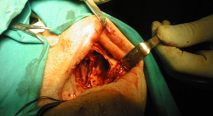 4-campo-operatorio-dopo-lexeresi-chirurgica 4-campo-operatorio-dopo-lexeresi-chirurgica