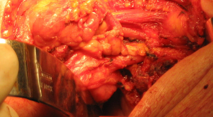 4-campo-operatorio-dopo-lexeresi-chirurgica 4-campo-operatorio-dopo-lexeresi-chirurgica