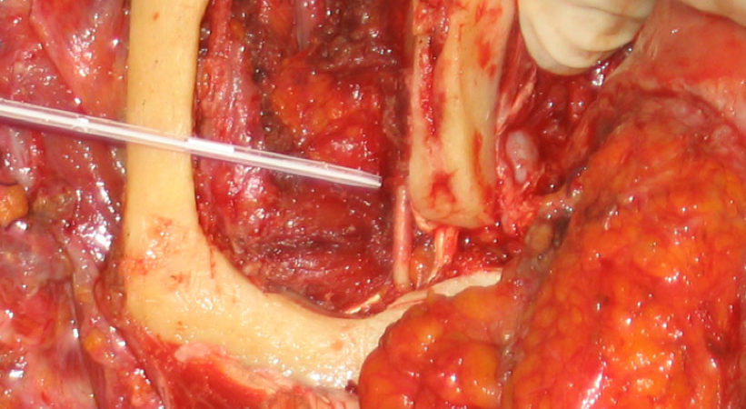 4-il-taglio-piezoelettrico-selettivo-per-losso-ha-permesso-di-conservare-il-nervo-mandibolare 4-il-taglio-piezoelettrico-selettivo-per-losso-ha-permesso-di-conservare-il-nervo-mandibolare