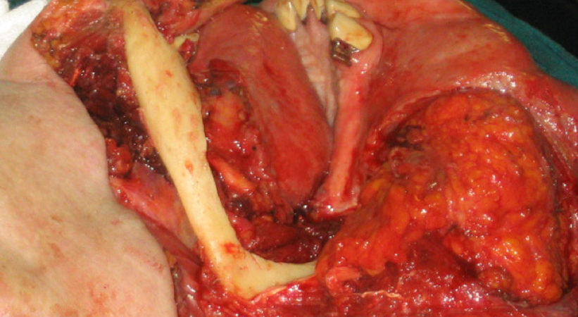 il-taglio-piezoelettrico-selettivo-per-losso-ha-permesso-di-conservare-il-nervo-mandibolare il-taglio-piezoelettrico-selettivo-per-losso-ha-permesso-di-conservare-il-nervo-mandibolare